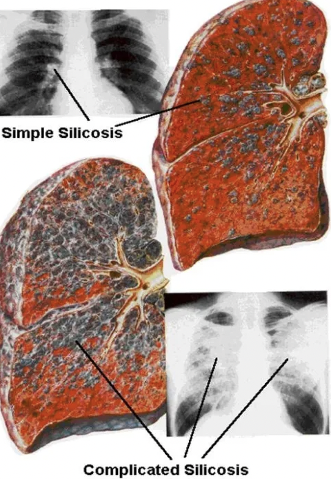 Silicosis